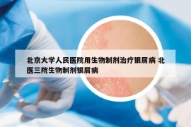 北京大學(xué)人民醫(yī)院用生物制劑治療銀屑病 北醫(yī)三院生物制劑銀屑病