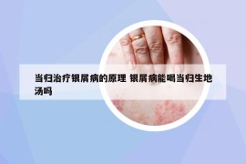 當(dāng)歸治療銀屑病的原理 銀屑病能喝當(dāng)歸生地湯嗎