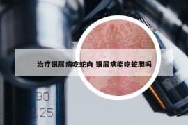 治療銀屑病吃蛇肉 銀屑病能吃蛇膽嗎