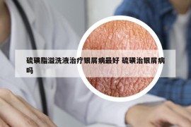 硫磺脂溢洗液治療銀屑病最好 硫磺治銀屑病嗎