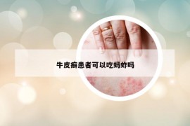 牛皮癬患者可以吃螞蚱嗎
