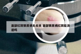 面部紅斑銀屑病無皮損 面部銀屑病紅斑能消退嗎