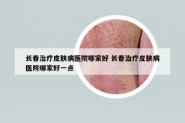 長春治療皮膚病醫(yī)院哪家好 長春治療皮膚病醫(yī)院哪家好一點