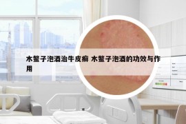 木鱉子泡酒治牛皮癬 木鱉子泡酒的功效與作用