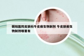 朝陽醫(yī)院皮膚科牛皮癬生物制劑 牛皮膚癬生物制劑哪里有