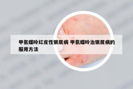 甲氨蝶呤紅皮性銀屑病 甲氨蝶呤治銀屑病的服用方法