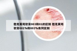 他克莫司軟膏003和01的區(qū)別 他克莫司軟膏001%和003%有何區(qū)別
