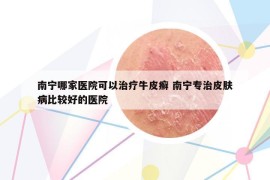 南寧哪家醫(yī)院可以治療牛皮癬 南寧專治皮膚病比較好的醫(yī)院
