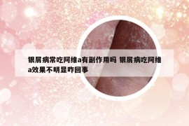 銀屑病常吃阿維a有副作用嗎 銀屑病吃阿維a效果不明顯咋回事