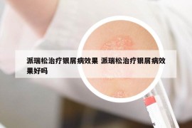 派瑞松治療銀屑病效果 派瑞松治療銀屑病效果好嗎