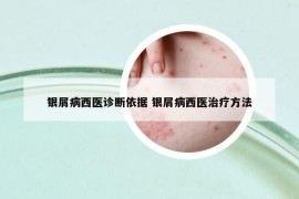 銀屑病西醫(yī)診斷依據(jù) 銀屑病西醫(yī)治療方法