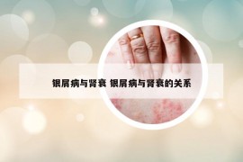 銀屑病與腎衰 銀屑病與腎衰的關系