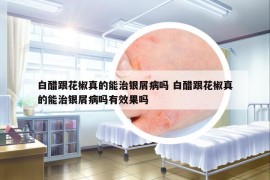 白醋跟花椒真的能治銀屑病嗎 白醋跟花椒真的能治銀屑病嗎有效果嗎