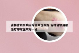 吉林省銀屑病治療哪家醫(yī)院好 吉林省銀屑病治療哪家醫(yī)院好一點
