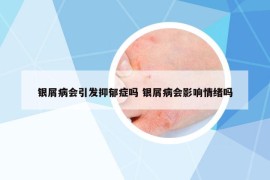 銀屑病會(huì)引發(fā)抑郁癥嗎 銀屑病會(huì)影響情緒嗎