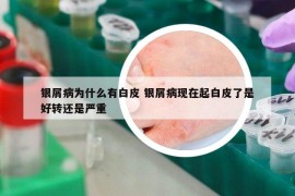 銀屑病為什么有白皮 銀屑病現(xiàn)在起白皮了是好轉(zhuǎn)還是嚴(yán)重