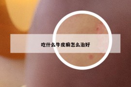 吃什么牛皮癬怎么治好