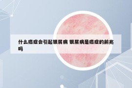 什么癌癥會引起銀屑病 銀屑病是癌癥的前兆嗎