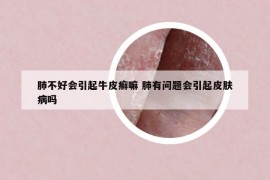 肺不好會引起牛皮癬嘛 肺有問題會引起皮膚病嗎