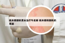 桃木根膽礬煮水治療牛皮癬 桃木根和膽礬的用途