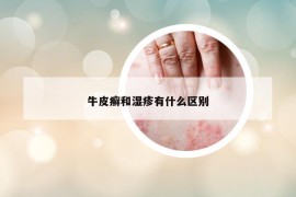 牛皮癬和濕疹有什么區(qū)別
