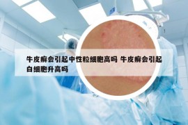 牛皮癬會引起中性粒細(xì)胞高嗎 牛皮癬會引起白細(xì)胞升高嗎