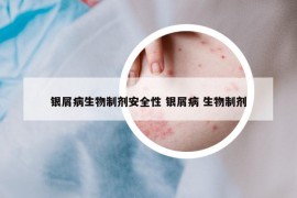 銀屑病生物制劑安全性 銀屑病 生物制劑