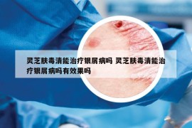 靈芝膚毒清能治療銀屑病嗎 靈芝膚毒清能治療銀屑病嗎有效果嗎