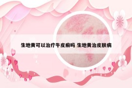 生地黃可以治療牛皮癬嗎 生地黃治皮膚病