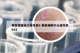 銀屑病是缺少維生素b 銀屑病缺什么維生素b12