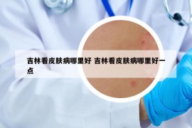 吉林看皮膚病哪里好 吉林看皮膚病哪里好一點