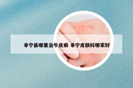 阜寧縣哪里治牛皮癬 阜寧皮膚科哪家好