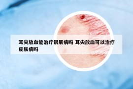 耳尖放血能治療銀屑病嗎 耳尖放血可以治療皮膚病嗎