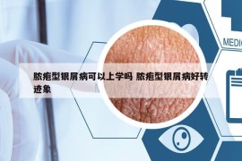 膿皰型銀屑病可以上學(xué)嗎 膿皰型銀屑病好轉(zhuǎn)跡象
