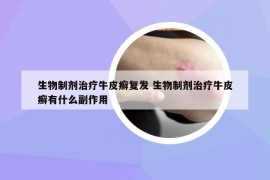 生物制劑治療牛皮癬復(fù)發(fā) 生物制劑治療牛皮癬有什么副作用