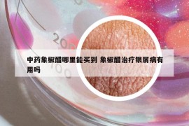 中藥象椒醋哪里能買到 象椒醋治療銀屑病有用嗎