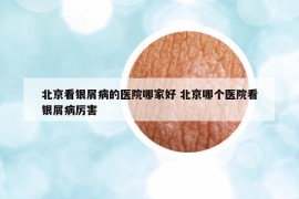 北京看銀屑病的醫(yī)院哪家好 北京哪個(gè)醫(yī)院看銀屑病厲害