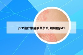 prP治療銀屑病關節(jié)炎 銀屑病pd1