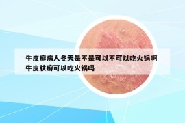 牛皮癬病人冬天是不是可以不可以吃火鍋啊 牛皮膚癬可以吃火鍋嗎