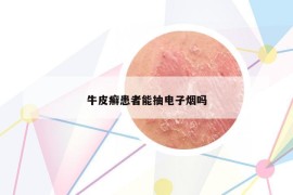 牛皮癬患者能抽電子煙嗎