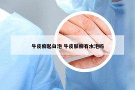 牛皮癬起白泡 牛皮膚癬有水泡嗎