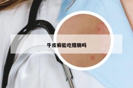 牛皮癬能吃臘腸嗎