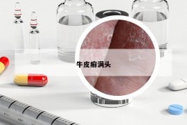 牛皮癬滿頭