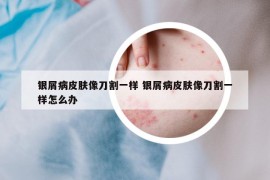 銀屑病皮膚像刀割一樣 銀屑病皮膚像刀割一樣怎么辦