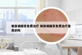 銀屑病國(guó)家免費(fèi)治療 銀屑病國(guó)家免費(fèi)治療是真的嗎