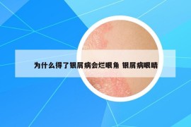 為什么得了銀屑病會爛眼角 銀屑病眼睛