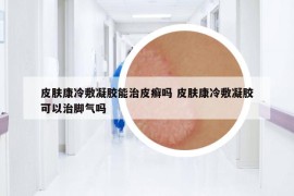 皮膚康冷敷凝膠能治皮癬嗎 皮膚康冷敷凝膠可以治腳氣嗎