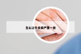 怎么讓牛皮癬嚴重一些