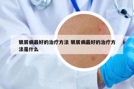 銀屑病最好的治療方法 銀屑病最好的治療方法是什么