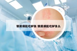 銀屑病能吃鱸魚 銀屑病能吃鱸魚么